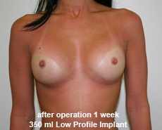 plastic-surgery-breast-augmentation